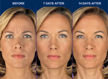 before and after pics of female patient 14 days after botox injection