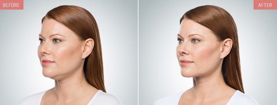 KYBELLA® before and after pics showing double chin reduction in a female