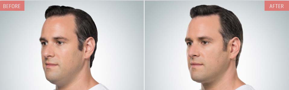KYBELLA® before and after pics showing double chin reduction in a male